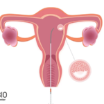 ivf embryo transfer 600X450 150x150