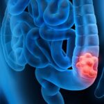 61952 AKTINOLOGOI – RADIOLOGOI Mpalafoyta Myrsini   Aktinotherapeytis Ogkologos Agia Paraskeyi Attikis colon cancer blog mainarticleimage 150x150